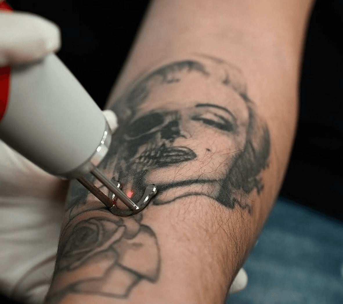Rimozione tattoo