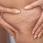 3 trattamenti contro la cellulite