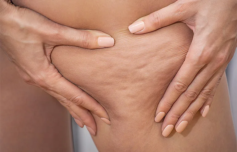 3 trattamenti contro la cellulite