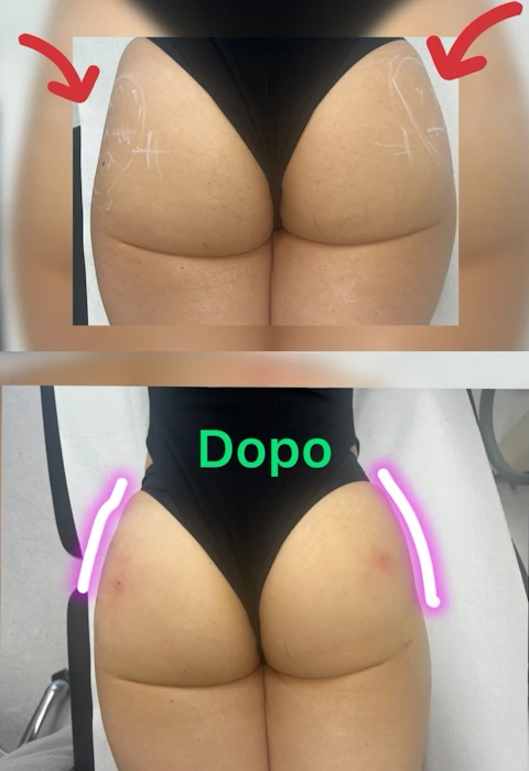 Foto filler glutei prima e dopo